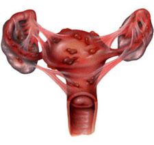 endometriosis-29529