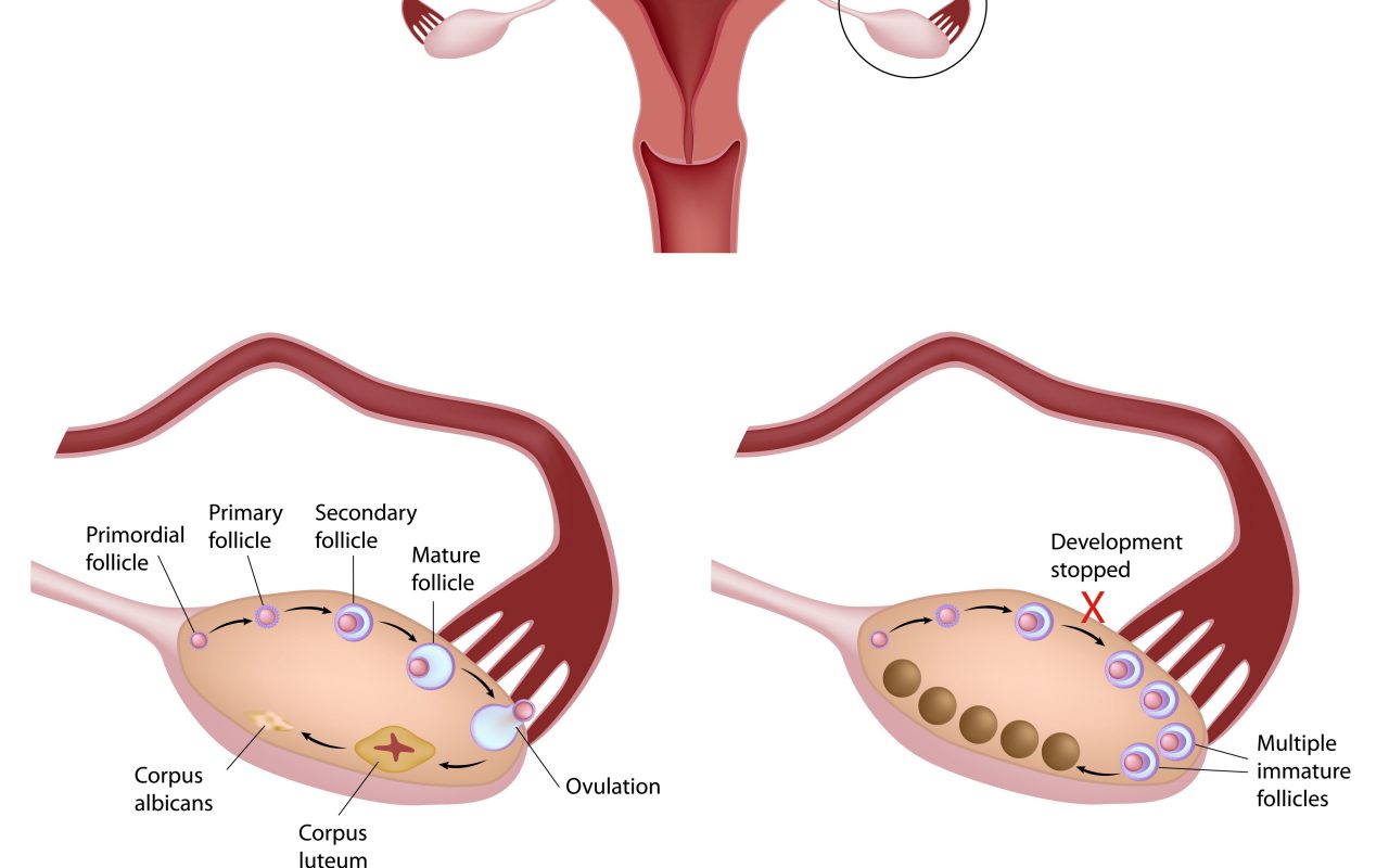 pcos