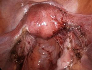 endometriosis-2