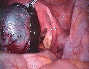 perforierte_endometriosezyste